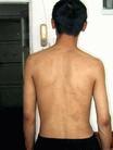 Published on 9/10/2003 Photo evidence: scars in a practitioner’s back due to electrical baton shocks. 