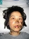 Published on 7/7/2004 The guards at the Longshan Labor Camp in Shenyang City shocked 36-year-old Falun Gong practitioner Ms. Gao Rongrong’s face and other parts of her body for nearly seven hours with electric batons, which severely disfigured her face.