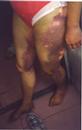 Published on 10/27/2000 On October 17, 2000, a female practitioner went to Tiananmen Square to appeal for Falun Gong, she was arrested and taken to the Tiananmen Police Station where she was electrocuted with electric batons and kicked for several hours. This series photo of her injured lower body were taken five days after being abused by the Tiananmen Police.