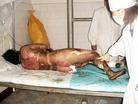 Published on 9/10/2004 Real burn patients are kept uncovered, and medical staff must wear clean white coats and masks over their mouths in order to prevent infection, completely opposite from the photos of the "Self Immolation" burn victims.