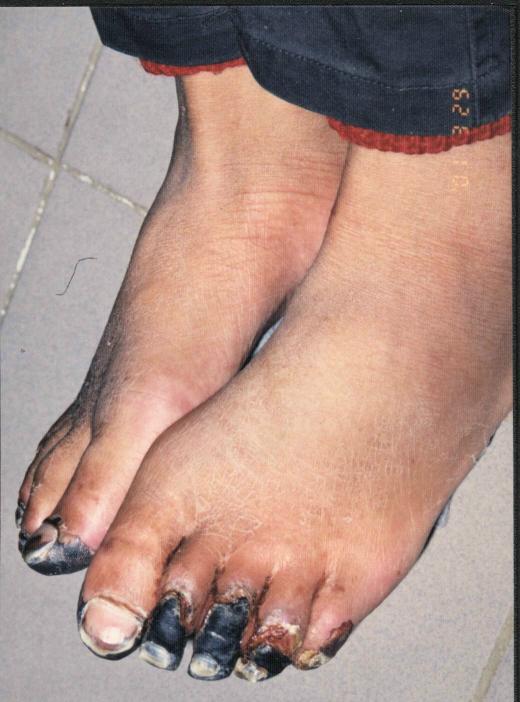 Frostbitten Toes Due to Torture. This Falun Dafa practitioner was arrested 