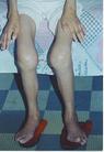 Published on 4/25/2004 Twenty six months of torture in the Second Forced Labor Camp in Gansu Province left both of Ms Zhai Fengci’s knees severely injured and swollen, and both hands deformed as well. She is unable to look after herself any more.