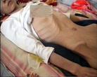 王霞　30岁，被呼和浩特女子监狱摧残以及注射不明药物，2004年6月体重只剩40多斤，昏迷不醒