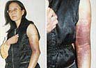 项进英(浙江)1999年10月25日被北京恶警长时间背铐而致上臂骨折，继被关押于莫干山女子劳教所