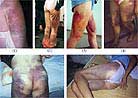 Published on 2000 Photographs of various injuries to the bodies of Falun Gong practitioners caused by torture.