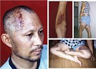 Published on 11/18/2004 Deep wounds and heavy bruises clearly visible on the head, arms, and legs of this Falun Gong practitioner.