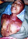 Published on 11/13/2000 Heilongjiang Practitioner Wang Bin was tortured to death on Septempber 24, 2000 by Daqing Men’s Labor Campa. Hosptial examination showed: a lymph artery was broken; over a dozen of his bones, including his collar bone, sternum and ribs were broken; one of Wang’s testicles was also split; the backs of Wang’s hands were found to have been repeatedly burned; Wang’s nostrils were burned and injured by the lit cigarettes that were inserted into them; and many parts of Wang’s body were black and dark purple..  