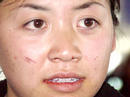 Published on 2/17/2002 湾区法功学员李春泉十五日从北京返回湾区，脸上仍有在北京遭毒打的伤痕。