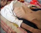 Published on 8/13/2004 Inter Mongolian practitioner Wang Xia terribly emaciated in the Huhehaote City Women’s Prison.
