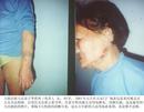 Published on 3/16/2001 山东大法弟子唐正林(化名)于2001年元旦到天安门广场表达意见，被公安非法关押在北京门头沟看守所，在看守所，狱警用电刑，用木棒打，人性全无，这是出狱后拍的照片。
