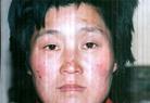 9/18/2002发表.山东安丘大法弟子赵凤英面部被不法之徒用烟头烧伤的照片