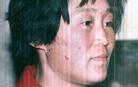 Published on 9/18/2002 山东安丘大法弟子赵凤英面部被不法之徒用烟头烧伤的照片
